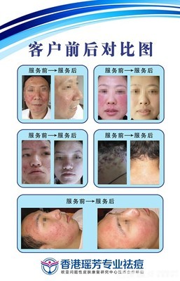 【香港瑤芳9點(diǎn)9元祛痘團(tuán)購(gòu)】_泉州國(guó)貿(mào)商城香港瑤芳專(zhuān)業(yè)祛痘團(tuán)購(gòu)10元_糯米麗人團(tuán)購(gòu)